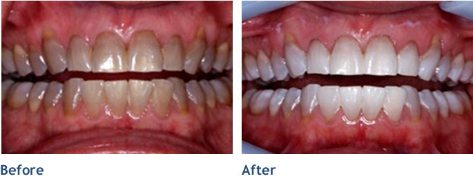 Whitening can take these dull teeth and make them brilliant