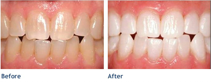 Go from yellowed to white without sensitivity